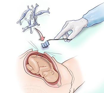 Illustration of patch surgery for spina bifida